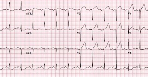 st elevation vs lvh